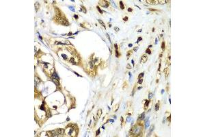 Immunohistochemistry of paraffin-embedded human liver cancer using TMOD4 antibody at dilution of 1:100 (x40 lens). (Tropomodulin 4 Antikörper)