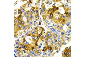 Immunohistochemistry of paraffin-embedded human liver cancer using CDK20 antibody. (CCRK Antikörper)