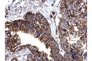 IHC-P Image IFITM1 antibody detects IFITM1 protein at cytosol and membrane on human ovarian carcinoma by immunohistochemical analysis.