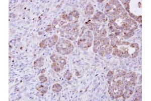 IHC-P Image Immunohistochemical analysis of paraffin-embedded NCIN87 xenograft, using Amphiphysin, antibody at 1:100 dilution. (Amphiphysin Antikörper  (N-Term))