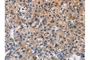 The image on the left is immunohistochemistry of paraffin-embedded Human liver cancer tissue using ABIN7128679(BPI Antibody) at dilution 1/50, on the right is treated with fusion protein. (BPI Antikörper)
