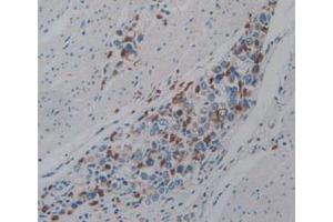 IHC-P analysis of Human Stomach Cancer Tissue, with DAB staining. (PTPRQ Antikörper  (AA 36-294))
