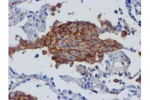 Immunohistochemical staining of paraffin-embedded Carcinoma of Human lung tissue using anti-CD80 mouse monoclonal antibody. (CD80 Antikörper)