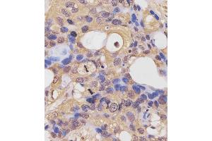 (ABIN6243855 and ABIN6577442) staining RK7 in human breast carcinoma sections by Immunohistochemistry (IHC-P - raformaldehyde-fixed, raffin-embedded sections). (PARK7/DJ1 Antikörper  (C-Term))