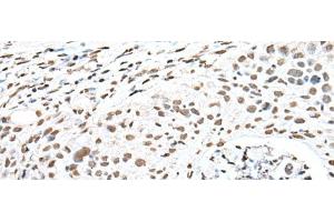 Immunohistochemistry of paraffin-embedded Human lung cancer tissue using SNRPA Polyclonal Antibody at dilution of 1:30(x200) (SNRPA1 Antikörper)