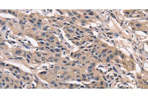 Immunohistochemistry of paraffin-embedded Human lung cancer using PEBP1 Polyclonal Antibody at dilution of 1:40 (PEBP1 Antikörper)