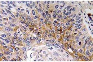 Immunohistochemistry (IHC) analyzes of Cardiotrophin-1 antibody in paraffin-embedded human lung carcinoma tissue. (Cardiotrophin 1 Antikörper)