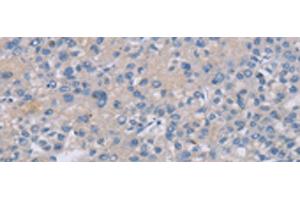 Immunohistochemistry of paraffin-embedded Human liver cancer tissue using CREBZF Polyclonal Antibody at dilution of 1:50(x200) (CREBZF Antikörper)