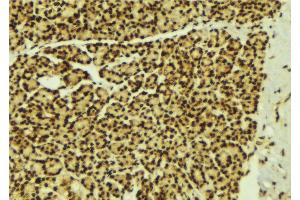 ABIN6269279 at 1/100 staining Human breast cancer tissue by IHC-P. (STAT5B Antikörper  (C-Term))
