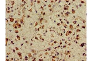Immunohistochemistry of paraffin-embedded human glioma using ABIN7155470 at dilution of 1:100 (ASH1L Antikörper  (AA 1906-2160))