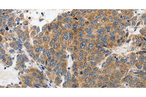 Immunohistochemistry of paraffin-embedded Human liver cancer tissue using GluR2 Polyclonal Antibody at dilution 1:70 (GRIA2 Antikörper)