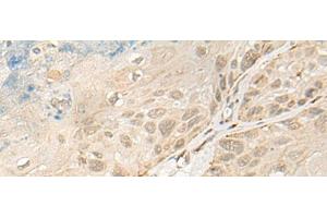 Immunohistochemistry of paraffin-embedded Human esophagus cancer tissue using OTX1 Polyclonal Antibody at dilution of 1:30(x200) (OTX1 Antikörper)