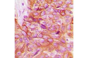 Immunohistochemical analysis of Alpha-adducin staining in human breast cancer formalin fixed paraffin embedded tissue section.