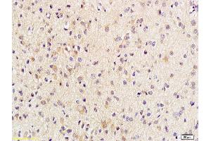 Formalin-fixed and paraffin embedded human brain glioblastoma labeled with Anti-Phospho-Beta-Catenin (Thr41/Ser45) Polyclonal Antibody, Unconjugated (ABIN683953) at 1:200 followed by conjugation to the secondary antibody and DAB staining (beta Catenin Antikörper  (pSer45, pThr41))