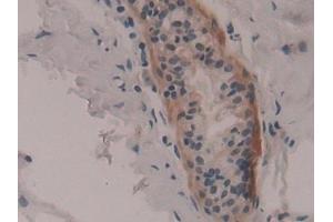 Detection of RPS6Ka1 in Human Breast cancer Tissue using Polyclonal Antibody to Ribosomal Protein S6 Kinase Alpha 1 (RPS6Ka1) (RPS6KA1 Antikörper  (AA 62-321))