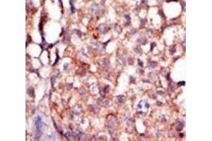 IHC analysis of FFPE human breast carcinoma tissue stained with the RIPK4 antibody (RIPK4 Antikörper  (AA 802-832))