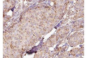 ABIN6278011 at 1/100 staining Human breast cancer tissue by IHC-P. (NDUFAF1 Antikörper  (N-Term))