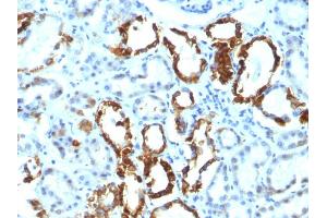Formalin-fixed, paraffin-embedded human Renal Cell Carcinoma stained with Milk Fat Globule Monoclonal Antibody (EDM45) (MFGE8 Antikörper)