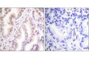 Immunohistochemistry analysis of paraffin-embedded human lung carcinoma tissue, using PIAS1 Antibody. (PIAS1 Antikörper  (AA 10-59))