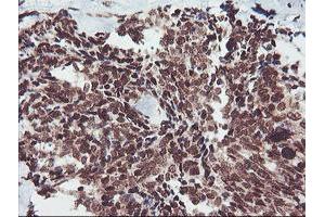 Immunohistochemical staining of paraffin-embedded Adenocarcinoma of Human breast tissue using anti-FMR1 mouse monoclonal antibody.