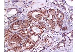 Formalin-fixed and paraffin embedded human thyroid carcinoma labeled Anti-B7H4 Polyclonal Antibody, Unconjugated (ABIN671736) at 1:200, followed by conjugation to the secondary antibody and DAB staining (VTCN1 Antikörper  (AA 50-100))