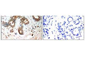 Immunohistochemical analysis of paraffin-embedded human breast carcinoma tissue, using 14-3-3 ζ (Phospho-Ser58) antibody (E011181). (14-3-3 zeta Antikörper  (pSer58))