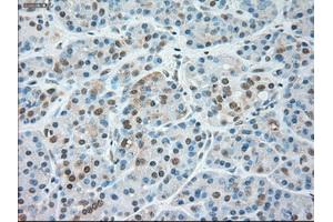 Immunohistochemical staining of paraffin-embedded Carcinoma of liver tissue using anti-SIGLEC9mouse monoclonal antibody. (SIGLEC9 Antikörper)