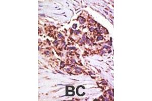 Formalin-fixed and paraffin-embedded human cancer tissue reacted with the primary antibody, which was peroxidase-conjugated to the secondary antibody, followed by DAB staining. (USP13 Antikörper  (AA 389-419))