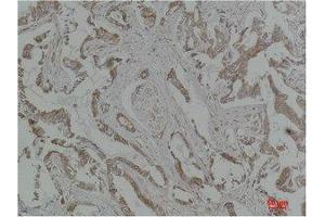 Immunohistochemistry (IHC) analysis of paraffin-embedded Human Breast Carcinoma using MEK-5 Polyclonal Antibody. (MAP2K5 Antikörper)