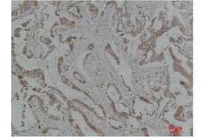 Immunohistochemistry (IHC) analysis of paraffin-embedded Human Breast Carcinoma using MEK-5 Polyclonal Antibody.