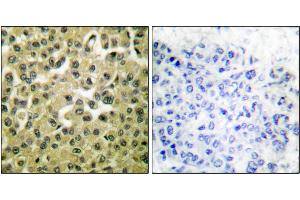 Immunohistochemical analysis of paraffin-embedded human breast carcinoma tissue using MCL1 antibody.