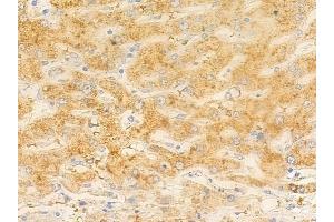 ABIN6265267 and ABIN6277996 at 1/100 staining human hepatocellular carcinoma by IHC-P.