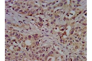 IHC image of ABIN7155172 diluted at 1:500 and staining in paraffin-embedded human liver cancer performed on a Leica BondTM system. (SLC7A1 Antikörper  (AA 430-492))