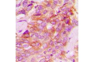 Immunohistochemical analysis of JAK1 staining in human breast cancer formalin fixed paraffin embedded tissue section. (JAK1 Antikörper  (C-Term))