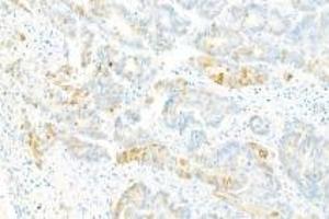 Immunohistochemistry analysis of paraffin-embedded Human ovarian cancer using Collagen X (ABIN7073549) at dilution of 1: 2000 (COL10 Antikörper)