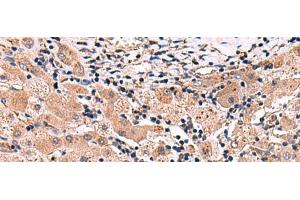 Immunohistochemistry of paraffin-embedded Human liver cancer tissue using INSC Polyclonal Antibody at dilution of 1:65(x200)