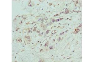 Immunohistochemistry of paraffin-embedded human pancreatic cancer using ABIN7148459 at dilution of 1:100