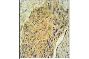 AVP Antibody (Center) (ABIN651748 and ABIN2840385) immunohistochemistry analysis in formalin fixed and paraffin embedded human lung carcinoma followed by peroxidase conjugation of the secondary antibody and DAB staining. (Vasopressin Antikörper  (AA 102-129))