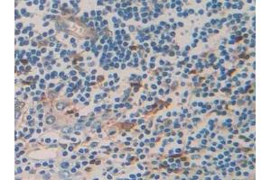 Detection of TNFRSF12A in Human Prostate cancer Tissue using Polyclonal Antibody to Tumor Necrosis Factor Receptor Superfamily, Member 12A (TNFRSF12A) (TNFRSF12A Antikörper  (AA 24-126))