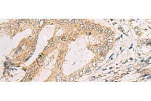 Immunohistochemistry of paraffin-embedded Human cervical cancer tissue using SPACA1 Polyclonal Antibody at dilution of 1:50(x200)