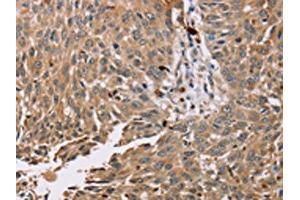 The image on the left is immunohistochemistry of paraffin-embedded Human lung cancer tissue using ABIN7130575(PDLIM7 Antibody) at dilution 1/35, on the right is treated with fusion protein. (PDLIM7 Antikörper)