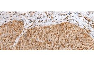 Immunohistochemistry of paraffin-embedded Human cervical cancer tissue using ZNF354A Polyclonal Antibody at dilution of 1:40(x200) (ZNF354A Antikörper)