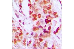 Immunohistochemical analysis of DDX52 staining in human breast cancer formalin fixed paraffin embedded tissue section. (DDX52 Antikörper  (C-Term))