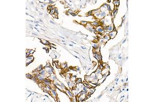 Immunohistochemistry of paraffin-embedded Human breast ductal carcinoma using δ-Catenin/p120 Catenin antibody (ABIN7266144) at dilution of 1:500 (40x lens). (CTNND1 Antikörper)