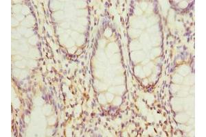 Immunohistochemistry of paraffin-embedded human colon cancer using ABIN7156012 at dilution of 1:100 (HSDL2 Antikörper  (AA 1-345))