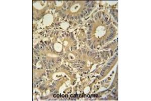 TPSD1 antibody (C-term) (ABIN654457 and ABIN2844191) immunohistochemistry analysis in formalin fixed and paraffin embedded human colon carcinoma followed by peroxidase conjugation of the secondary antibody and DAB staining. (TPSD1 Antikörper  (C-Term))