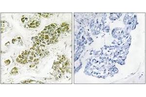 Immunohistochemistry analysis of paraffin-embedded human breast carcinoma tissue, using eIF2 alpha (Ab-51) Antibody. (EIF2A Antikörper  (AA 21-70))