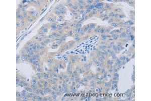 Immunohistochemistry of Human ovarian cancer using PAWR Polyclonal Antibody at dilution of 1:60 (PAWR Antikörper)