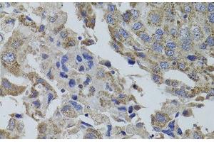 Immunohistochemistry of paraffin-embedded Human breast cancer using GNA15 Polyclonal Antibody at dilution of 1:100 (40x lens).