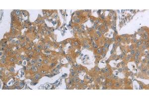 Immunohistochemistry of paraffin-embedded Human breast cancer using TNK2 Polyclonal Antibody at dilution of 1:70 (TNK2 Antikörper)